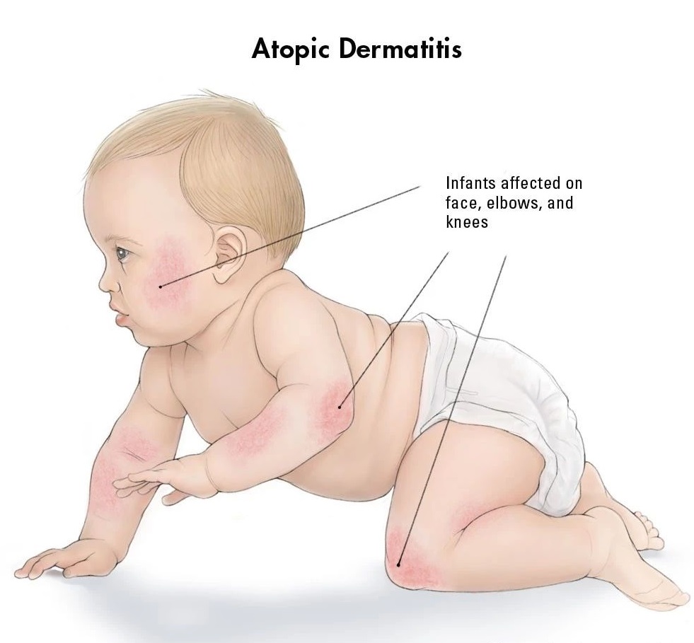 湿疹.jpg 湿疹.jpg